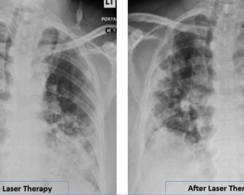 Radiographic Assessment of Lung Edema (RALE) by CXR showed reduced ground-glass opacities and consolidation following PBMT. Lung radiographic score is dependent on extent of involvement based on consolidation or ground-glass opacities for each lung. Total score is the sum of both lungs. RALE score before laser therapy=8. RALE score after laser therapy=5.